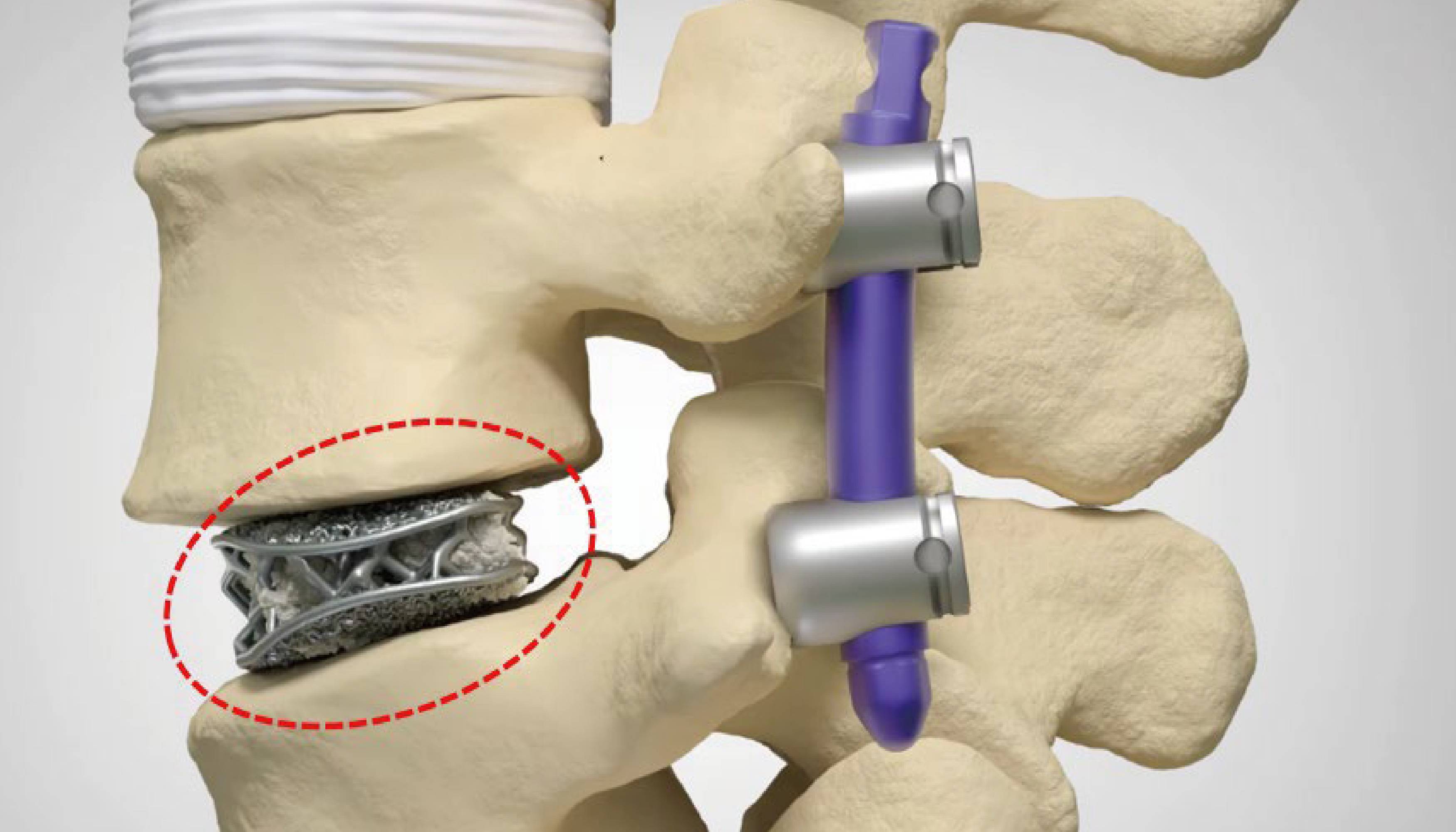 鈦竟能修復骨骼？醫生用它給患者裝上 “金剛狼爪”！